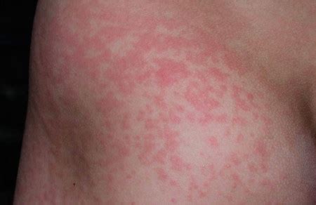 parvo meaning in tagalog|Parvovirus B19: Sanhi, prevention, sintomas, at gamot.